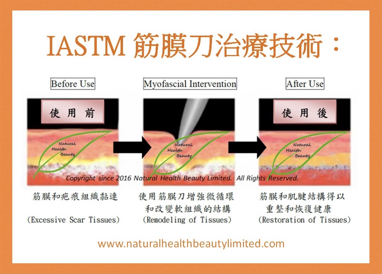 IASTM 專業版筋膜刀| www.magneticmassagerstore.com